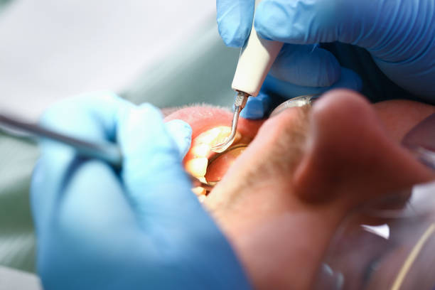Best Emergency Wisdom Teeth Removal in Escobares, TX